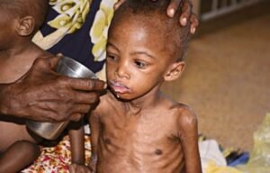 Read more about the article MALNUTRITION AND ITS EFFECTS